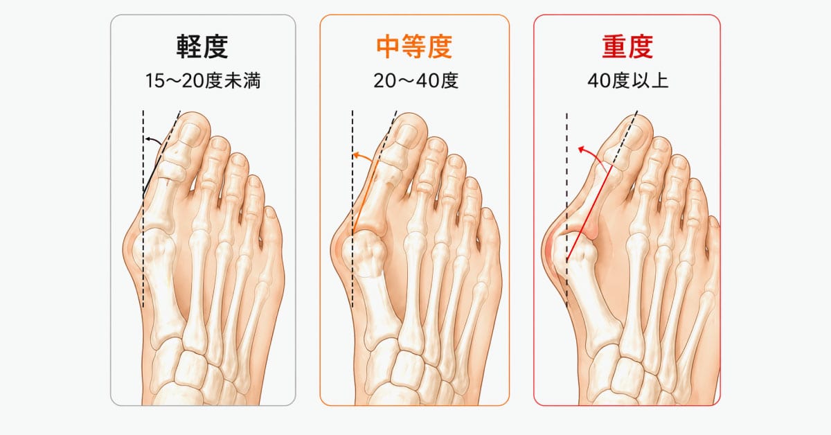 外反母趾でもパンプスを諦めない！痛みを防ぐ靴選び5ステップと毎日のケア